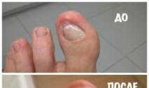 Болезни ногтей на ногах и руках, фото, описание, симптомы