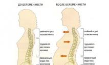 Возможны ли естественные роды при сколиозе Движение и физические нагрузки